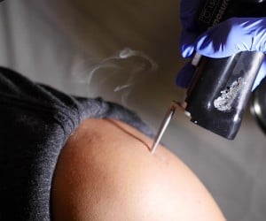 Science of Laser Hair Removal