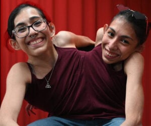 An Interview with Conjoined Twins